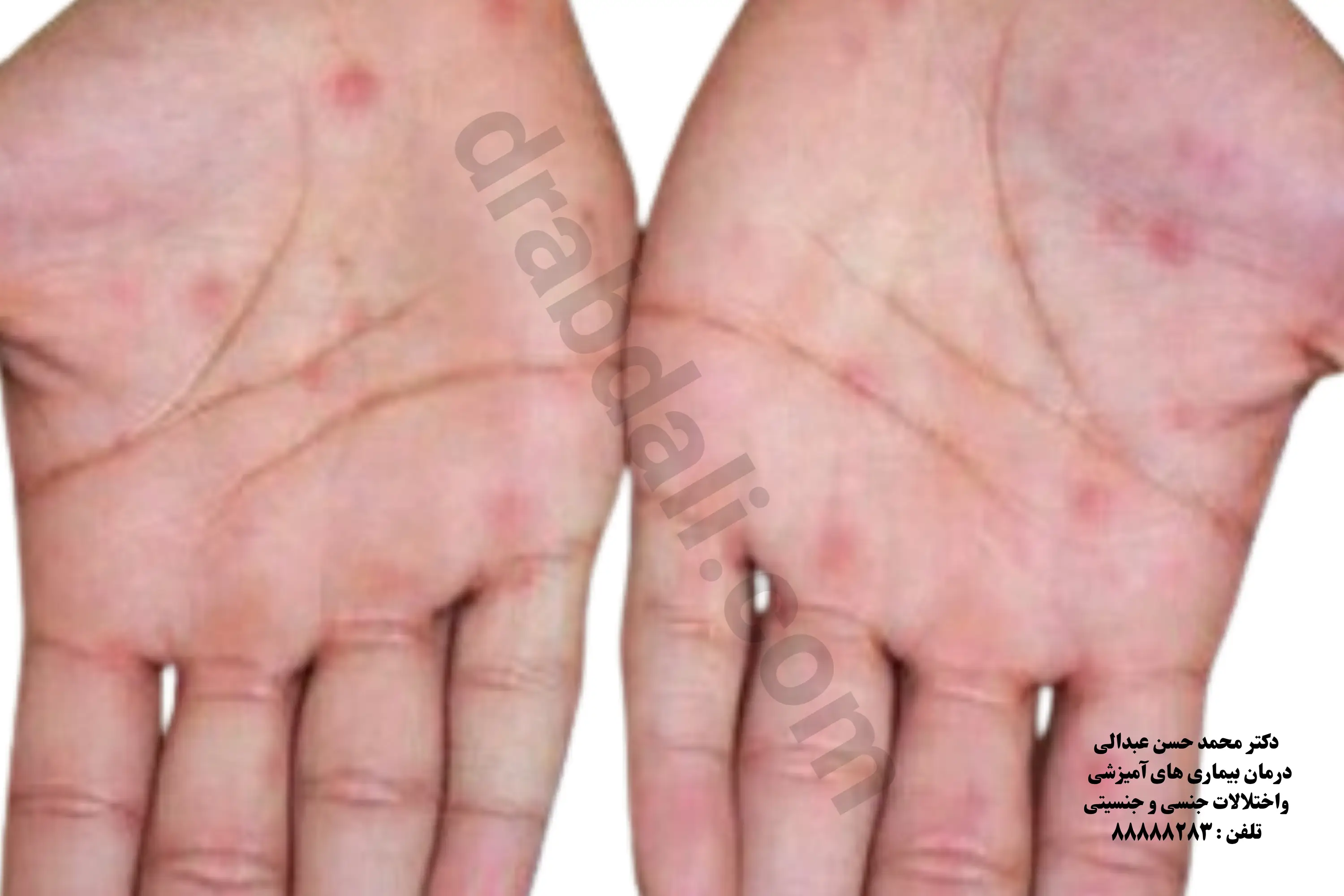 گالری عکس سیفیلیس
