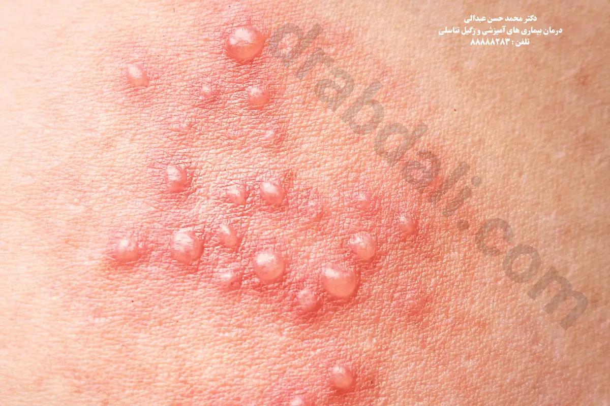 گالری عکس تبخال تناسلی